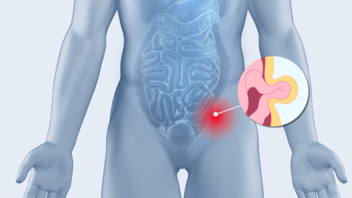 Операция на херния без разрез на мускули: PeTEP вече се прави в Пловдив